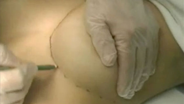 breast augmentation Los Angeles