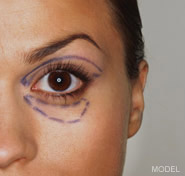 Featured Procedure - Eyelid Surgery